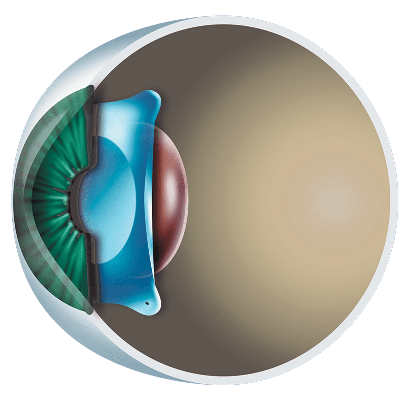 icl surgery malaysia